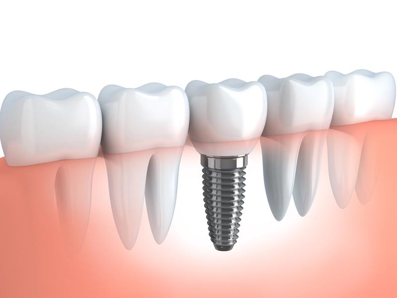 Dental Implants Bedford, NH 